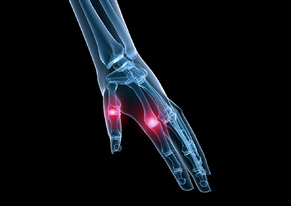 은평더바른신경외과 방아쇠손가락